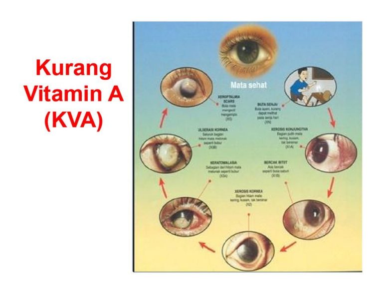 Suplementasi Vitamin A - Blog AhliGiziID